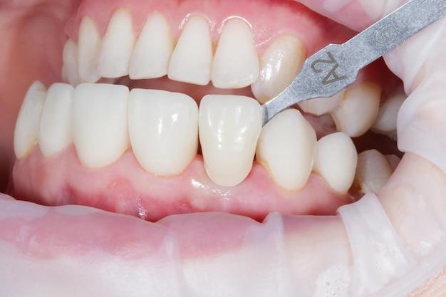 Are A2 teeth white? 