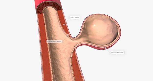 Can eye exam detect aneurysm 