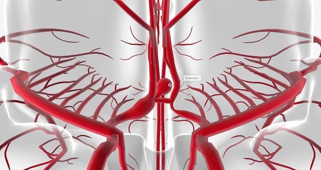 Can eye exam detect aneurysm 