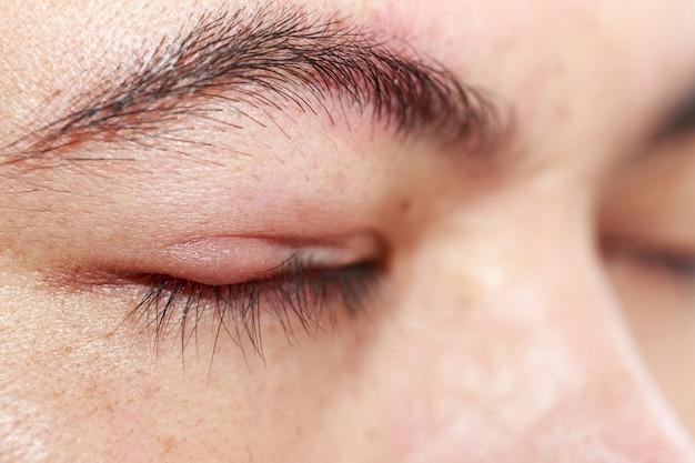 Can damaged eyebrow follicles be repaired? 