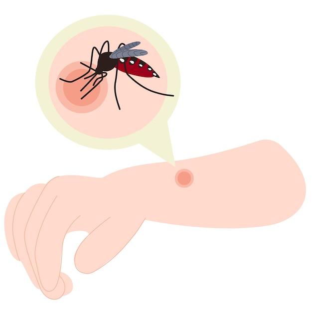 Does hand sanitizer help mosquito bites 