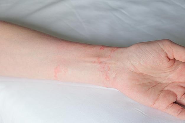 Can I be allergic to bamboo sheets? 