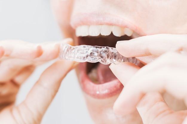 Can I change my Invisalign the night before? 