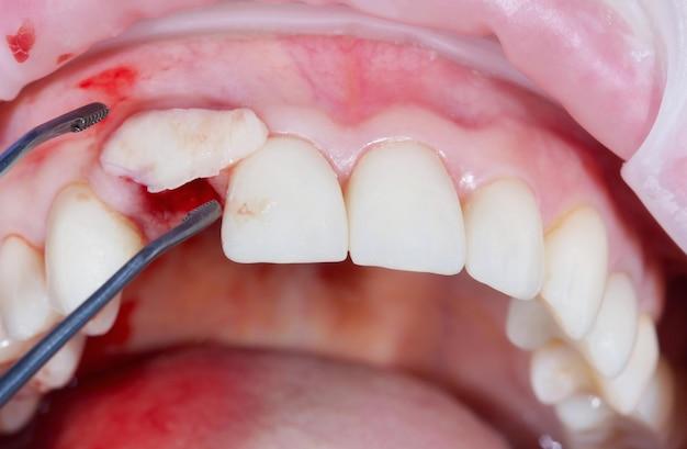 Can I drink soda after gum graft? 