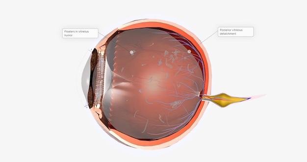 Can Stress Cause Posterior Vitreous Detachment Exploring The Link Between Stress And Eye Health 4870