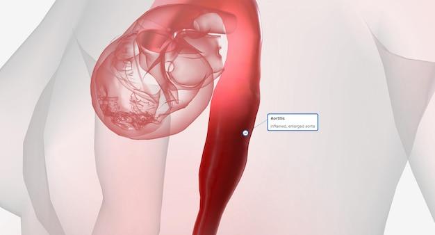 Can stress cause posterior vitreous detachment 