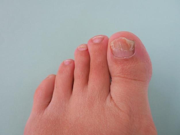 Can toenail fungus spread in the bathtub? 