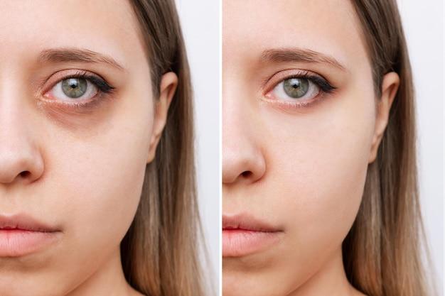 Can I use tretinoin for dark circles? 