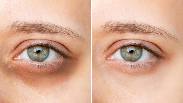 Can I use tretinoin for dark circles? 