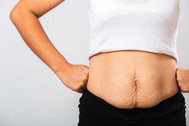 Can Vaseline remove stretch marks? 