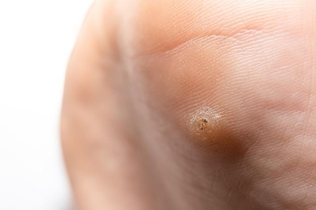 Can warts spread on clothing 