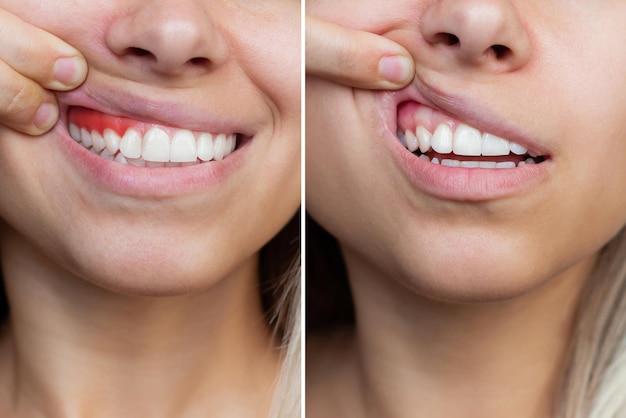 Can you see Invisalign in photos? 