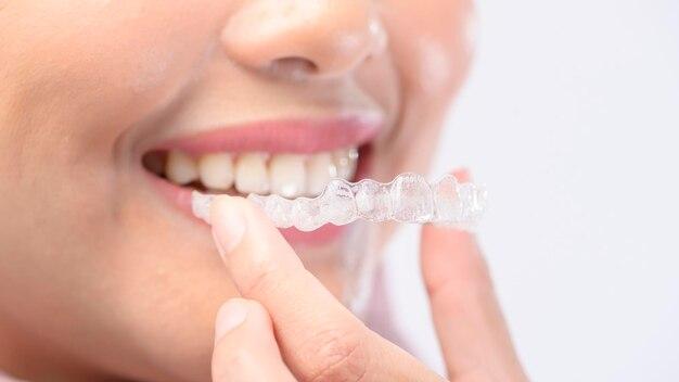 Can you see Invisalign in photos? 