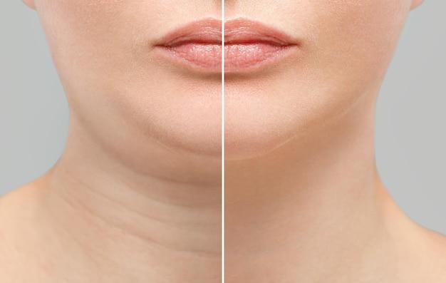 Does collagen make your face fat? 