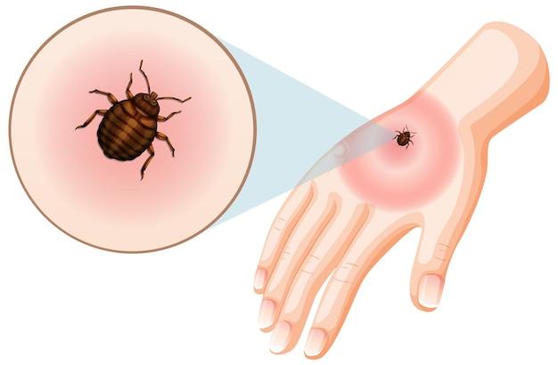 Does Febreze help bed bugs? 
