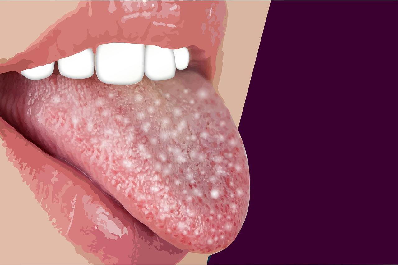 Does vaping give you white tongue? 