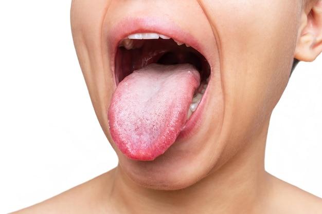 Does vaping give you white tongue? 