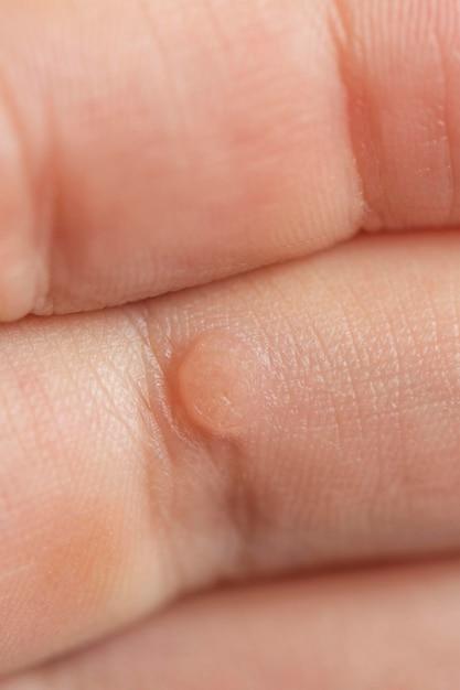 How long after a wart turns white does it fall off? 