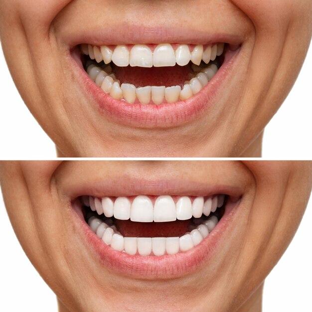 How long does it take for gums to heal after veneers? 