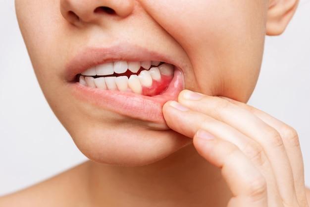How long does it take for gums to heal after veneers? 