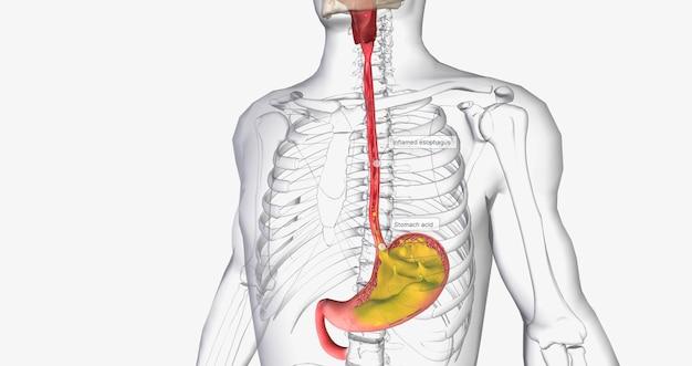 Is Gatorade good for acid reflux? 