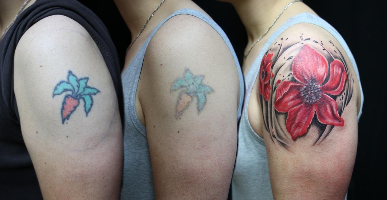 Is red or blue laser better for tattoo removal? 