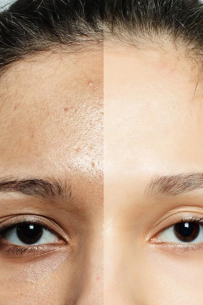 What happens if I sweat after microneedling 