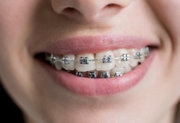 What is the next step after spacers for braces? 