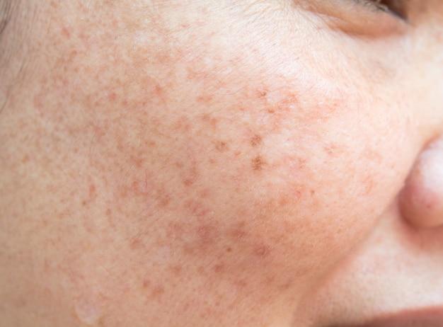 Why do some blackheads leave holes 