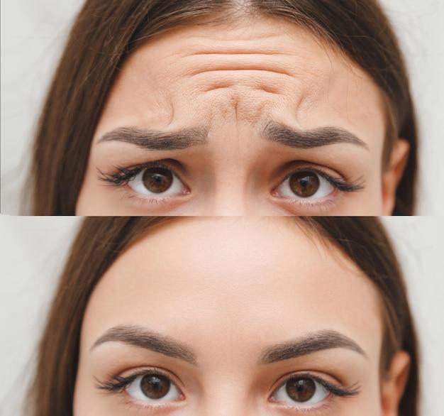 Why does Botox make your forehead shiny? 