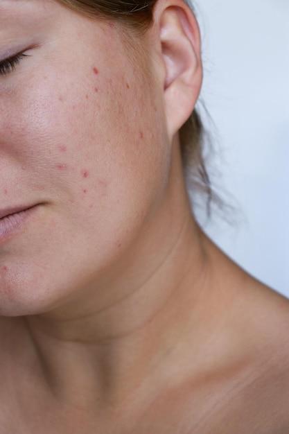 Why does my acne look worse after washing my face? 