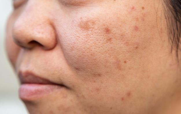 Why does my acne look worse after washing my face? 