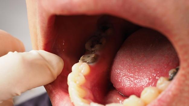 Will a tooth root come out on its own 