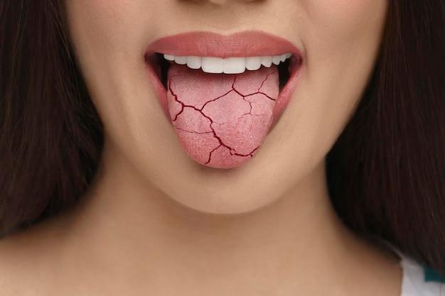 What does your tongue look like when your dehydrated 