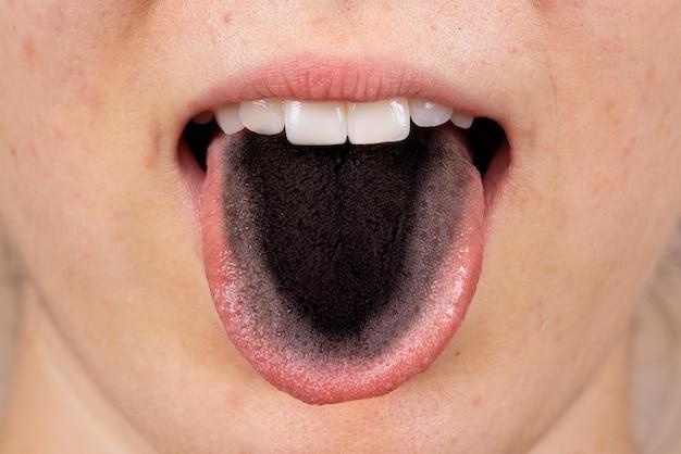 What does your tongue look like when your dehydrated 