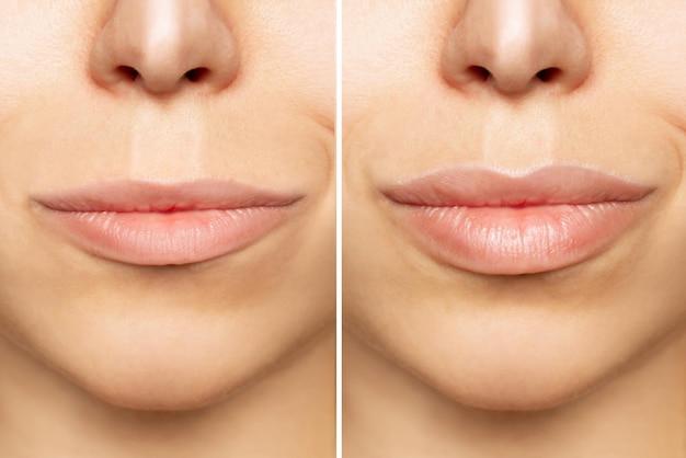 When can you give oral After lip fillers 