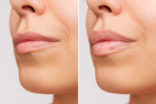 When can you give oral After lip fillers 